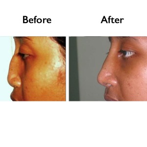 Nose suregry Before and After