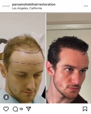 Celebrity FUE Hair Transplant