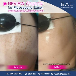 Chronic melasma treatment results Thailand
