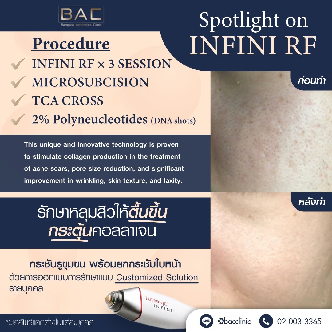 Melasma treatment