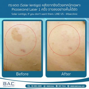 Acne Scar Treatment