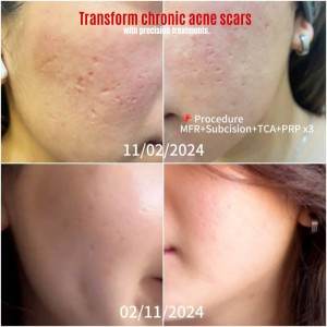 best clinic for acne scars Bangkok