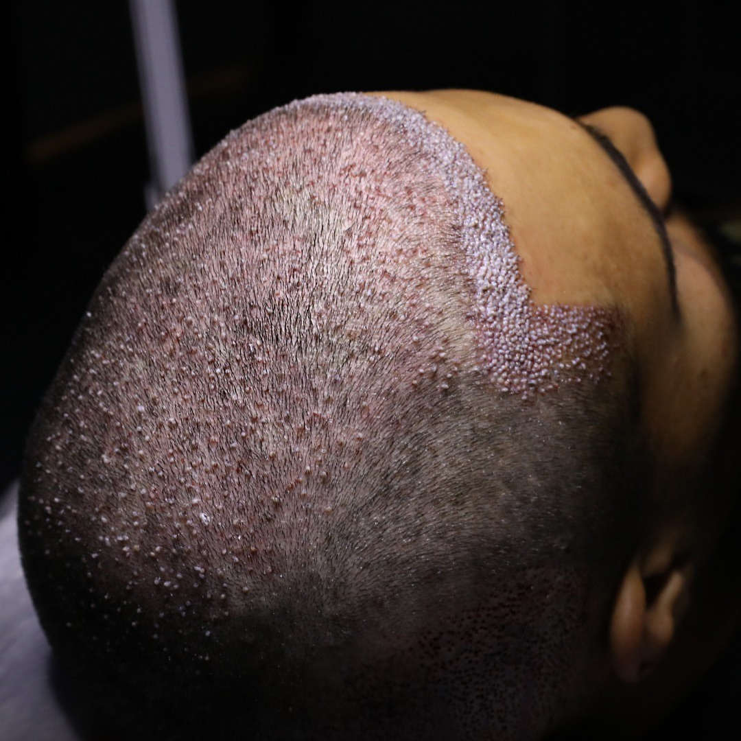 Hybrit method hair transplant procedure at Hair Center of Turkey