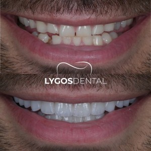 Rediscover your smile with Emax Veneers Witness our patients transformation into a natural and