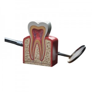 Root Canel Treatment