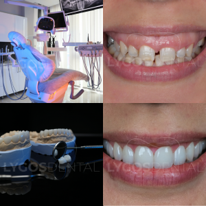 Lygos Dental before and after and clinical photo