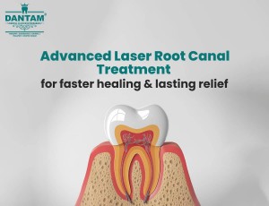 Advanced Laser Root Canal Treatment, Dantam