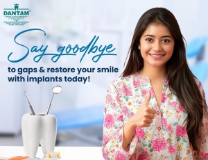 Best Dental Implants in Hyderabad