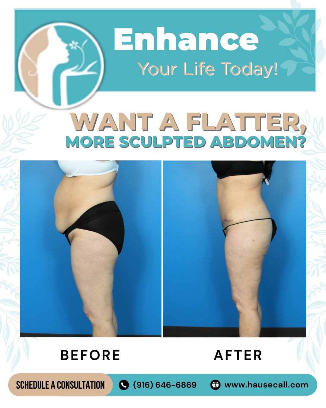 Sacramento Aesthetic Surgery Sculpted Abdomen Sacramento Aesthetic Surgery Sculpted Abdomen