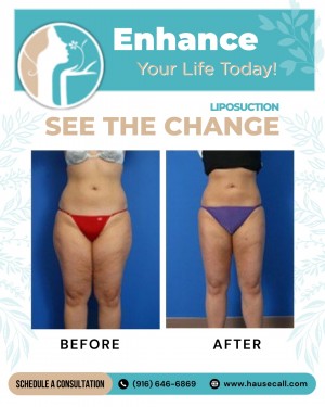 Sacramento Aesthetic Surgery Liposuction