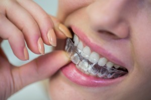 Top Invisalign provider in Hyderabad, Dantam Dental