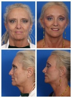 composite 16037108439072 jpg nggid018 ngg0dyn 300x300x100 00f0w010c010r110f110r010t010