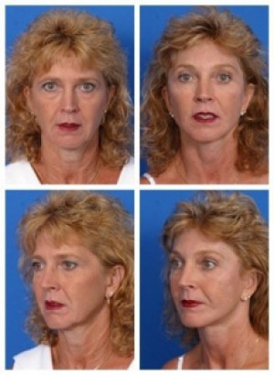 composite 16038893486247 jpg nggid0213 ngg0dyn 300x300x100 00f0w010c010r110f110r010t010