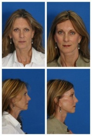 composite 16038897612407 jpg nggid0216 ngg0dyn 300x300x100 00f0w010c010r110f110r010t010