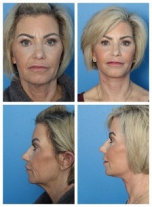 composite 16038904494353 jpg nggid0223 ngg0dyn 300x300x100 00f0w010c010r110f110r010t010