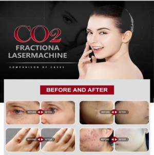 Scar Removal CO Fractional Laser Machines