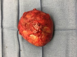 En bloc capsulectomy-breast implant surrounded by capsule removed together