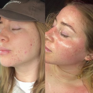 acne treatment colorado springs