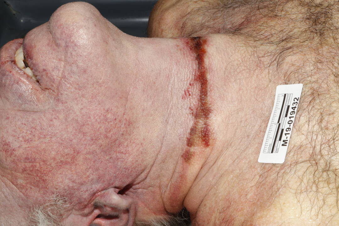 2924 EpsteinAutopsy 1080x720 courtesy Mark Epstein 2924 EpsteinAutopsy 1080x720 courtesy Mark Epstein