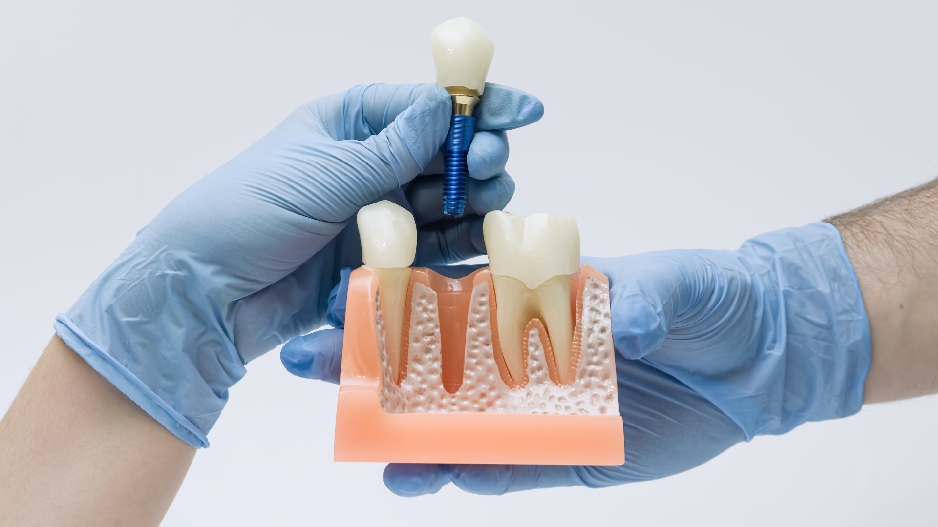Hutt Dental Implant Centre Brings Specialist Dental Implant Care to Lower Hutt
