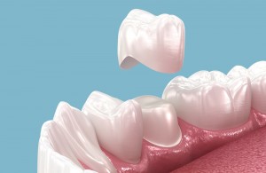 dental crown 3d placement