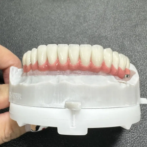 Sunflower Dental Lab Implant Restorations Engineering Stability