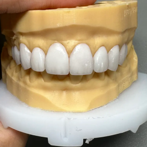 Sunflower Dental Lab Ultra Thin Veneers and E max All Ceramic