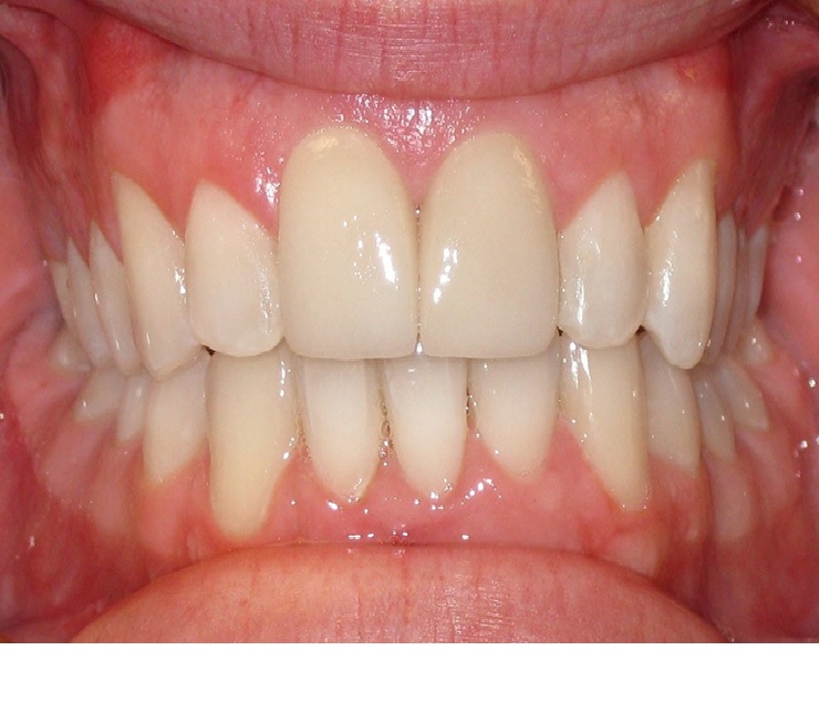 Orthodontics braces Lynbrook NY Orthodontics braces Lynbrook NY
