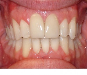Orthodontics braces Lynbrook NY