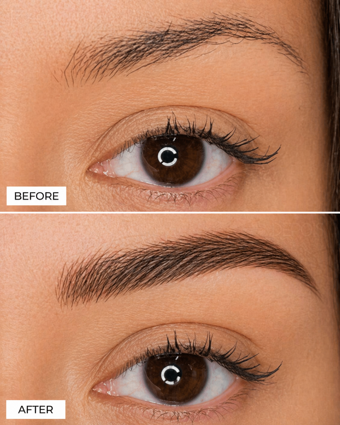 Eyebrow Hair Transplant Before and After  Natural Eyebrow Restoration