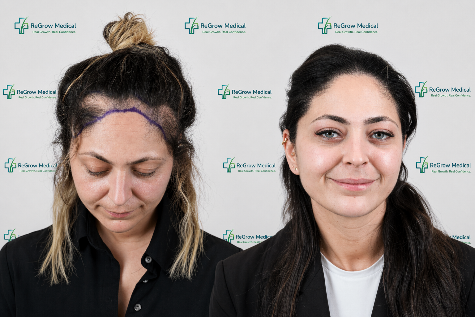 Female Hair Transplant Before and After  Hair Restoration Treatment