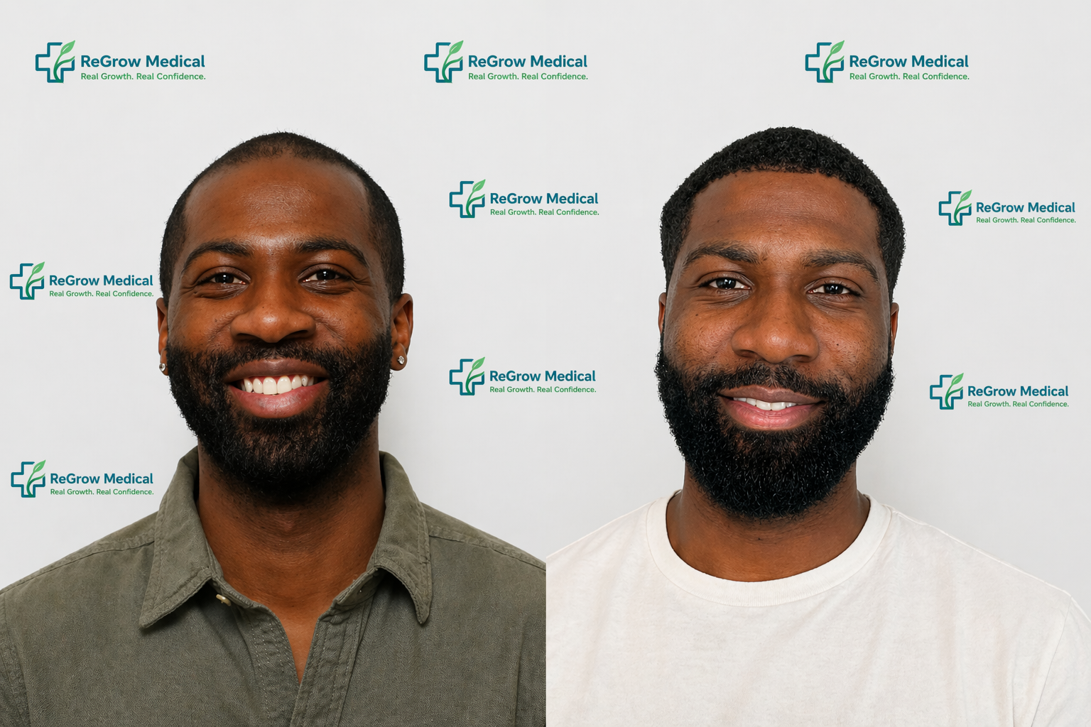 FUE Hair Transplant Before and After  Natural Hair Restoration Results