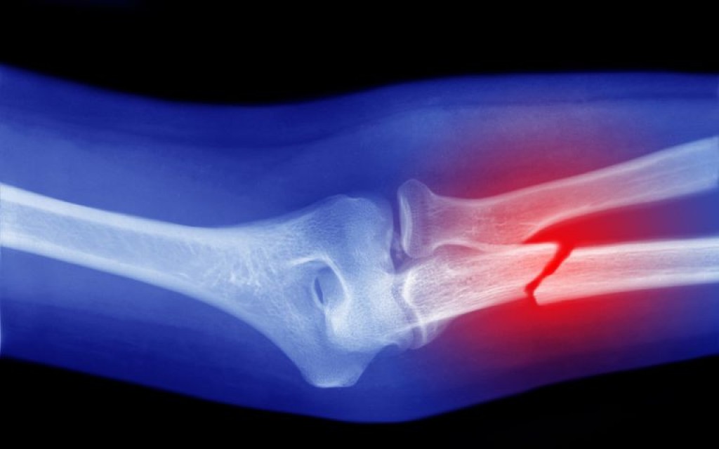 Brief Introduction of Trauma Bone Fractures Types IssueWire