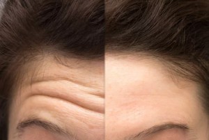 botox before and after