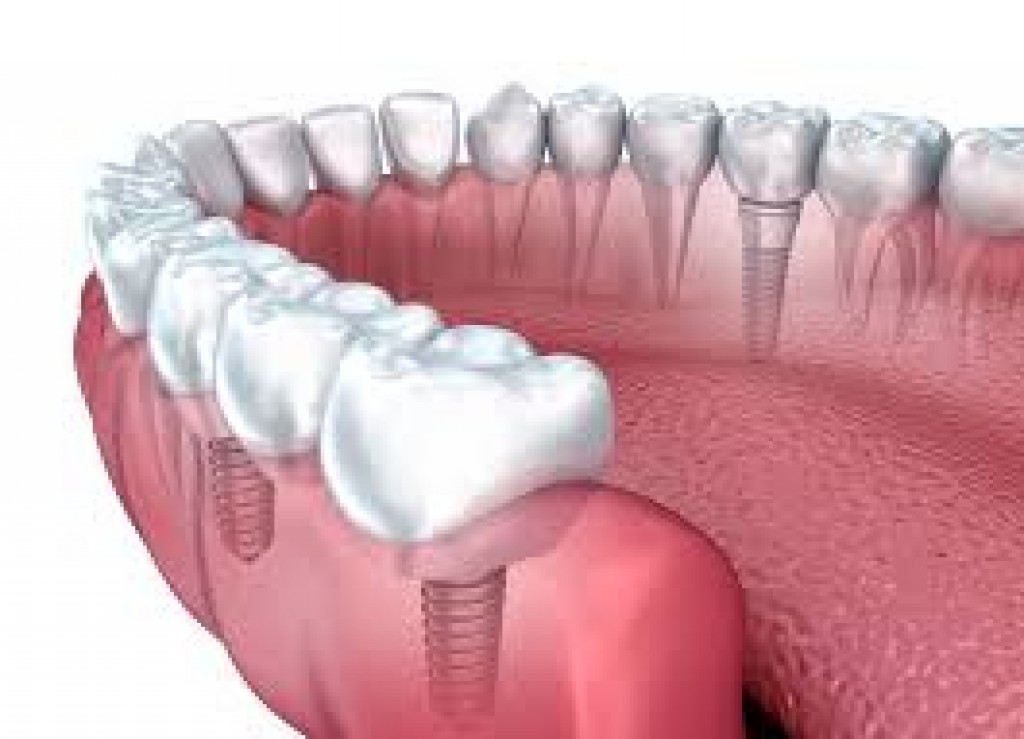 Dental Implants Los Angeles Jacob Elisha Periodontist IssueWire