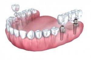 Dental Implants Los Angeles