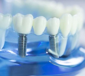 Dental Implants Los Angeles
