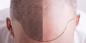 Best Hair Loss Treatments for Men