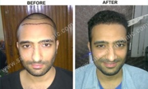 hair transplant before and after