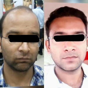 hair transplant results