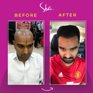 Hair transplant