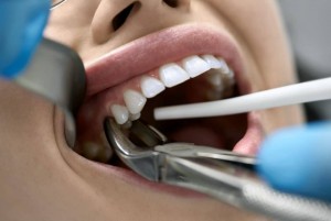 tooth extraction near me