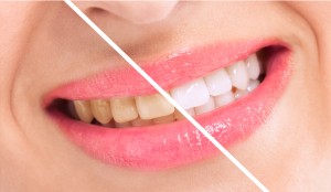 teeth cleaning and scaling