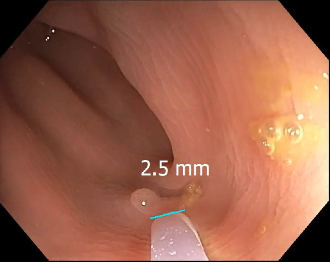 2 5 mm polyp detected and sized 2 5 mm polyp detected and sized