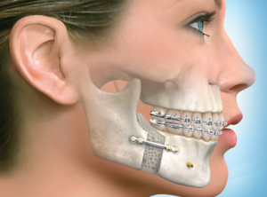 Broken Jaw Surgery