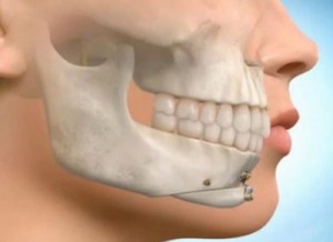 Jaw Surgery