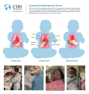 Congenital Diaphragmatic Hernia