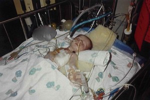 Shane Torrence was born with CDH and did not have enough functioning lung to survive.