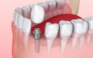 GCC Dental Implants Market