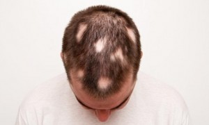 Alopecia